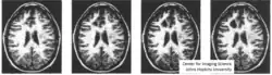 Illustration of changing both gray levels in an imaging which is classical warping from Michael Jackson video as well as diffeomorphic orbit transformation.,