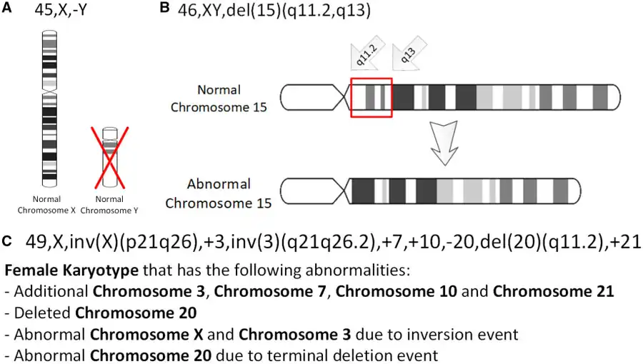 Three chromosomal abnormalities with ISCN nomenclature, with increasing complexity: (A) A tumour karyotype in a male with loss of the Y chromosome, (B) Prader–Willi Syndrome i.e. deletion in the 15q11-q12 region and (C) an arbitrary karyotype that involves a variety of autosomal and allosomal abnormalities.[54]